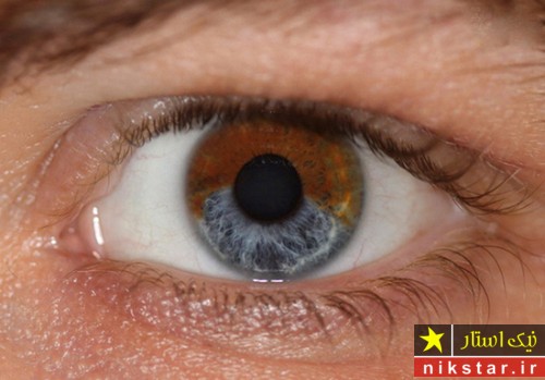 تغییر رنگ چشم با شوک عصبی