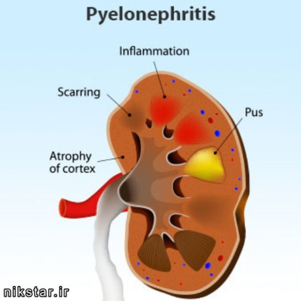 Почечная инфекция. Пиелонефрит это воспаление. Воспалительный процесс в почках.